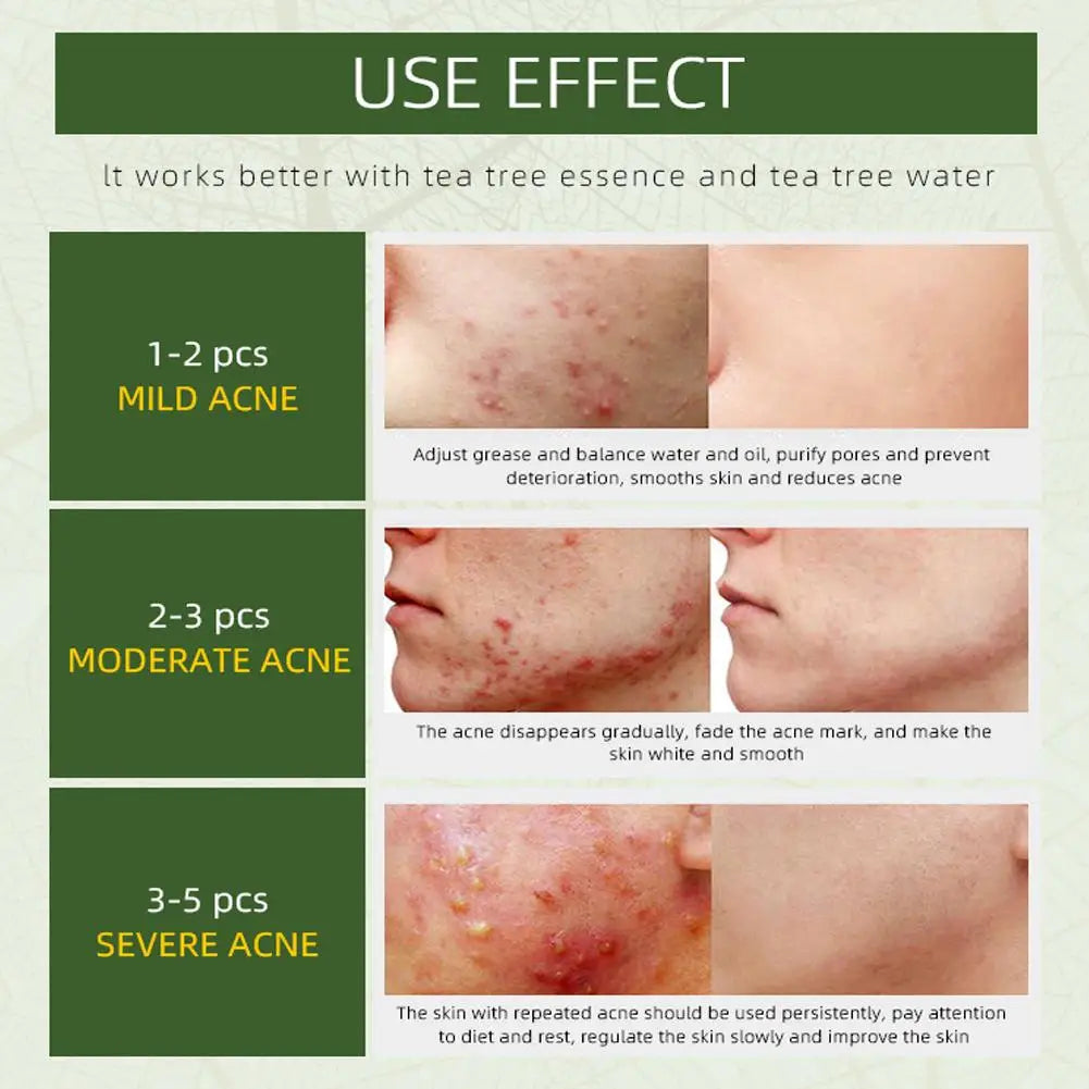 Herbal Acne Face Cream by JoyPretty - Pimple Marks RemovalOil Control & Moisturizing Facial Cream for Pockmark Smoothing