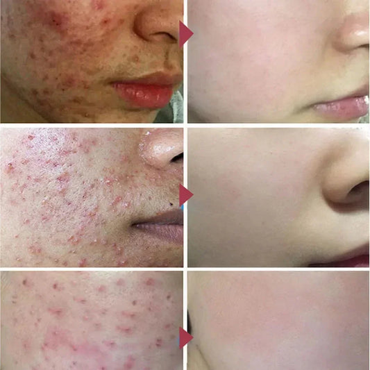 Herbal Acne Removal Face Cream Clears Pimple Scar Black Dots Gel Acne Treatment Shrink Pore Skin Whitening Lightening Ointment