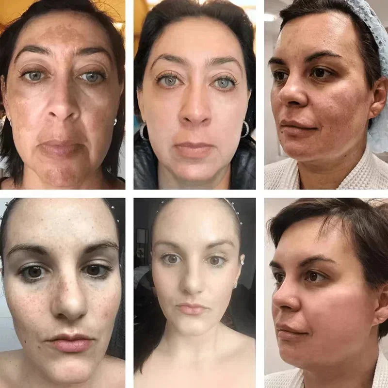 Powerful Dark Spots Remover Whiten Serum Cream Vitamin C Skin Brighten Serum Removal Melasma Dark Spots Repair Beauty Skin Care