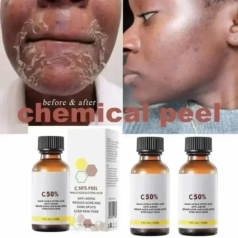 Salicylic Acid Face Facial Peel Neutraliser Face Deep At Home Chemical Peel Exfoliate Refine skin care serum NEW