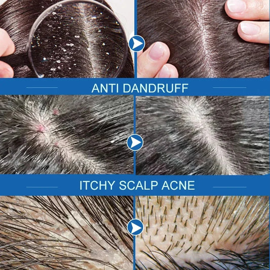 Fast Anti Dandruff Hair Treatment Scrub Itching Repair Scalp Cleaning Exfoliating Products Oil Control Antipruritic Hair Care