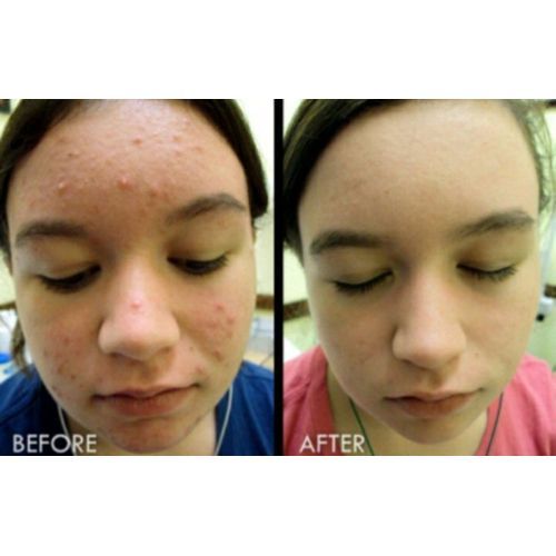 Dudu-Osun Black Soap-for Eczema,Acne,Freckle,oily Skin,Dark Spots