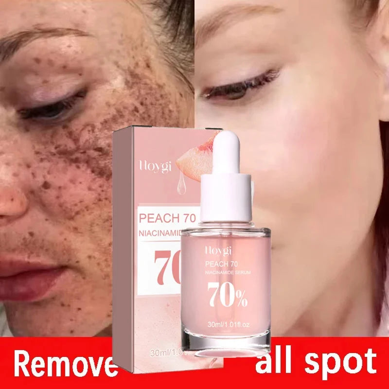 Niacinamide Whitening Freckles Serum Removal Melasma Dark Spots Lighten Melanin Pigmentation Brightening Anti-Aging Skin Care