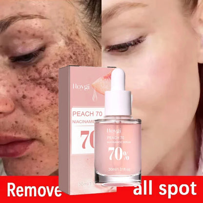 Niacinamide Whitening Freckles Serum Removal Melasma Dark Spots Lighten Melanin Pigmentation Brightening Anti-Aging Skin Care