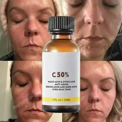 Salicylic Acid Face Facial Peel Neutraliser Face Deep At Home Chemical Peel Exfoliate Refine skin care serum NEW