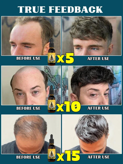 2025 Hair growth oil, repair baldness, hairline, rapid hair growth hair growth oil for men