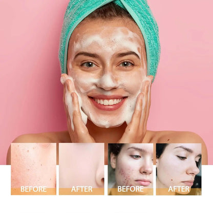 Turmeric Kojic Acid Blackhead Remover Cleanser Deeply Cleansing Skin Cleansing Oil Control Fade Acne Marks Brighten Foam Cleanse