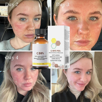 Salicylic Acid Face Facial Peel Neutraliser Face Deep At Home Chemical Peel Exfoliate Refine skin care serum NEW