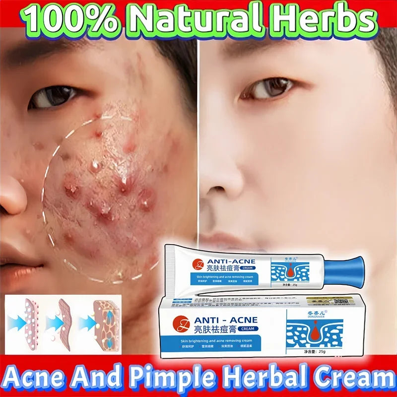 Herbal Acne Removal Face Cream Clears Pimple Scar Black Dots Gel Acne Treatment Shrink Pore Skin Whitening Lightening Ointment