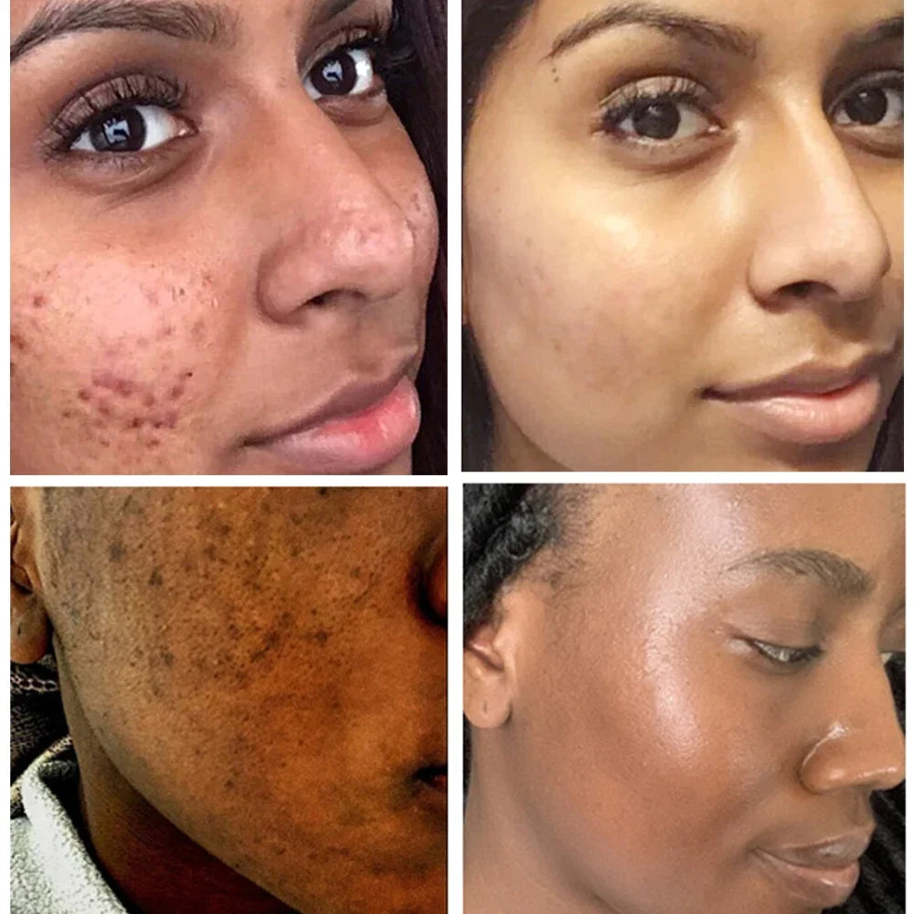 Turmeric lemon Skin Care products Acne Dark Spot Remover Whitening Brighten Facial Serum Face Cream Cleanser Serum Oil Cosmetics