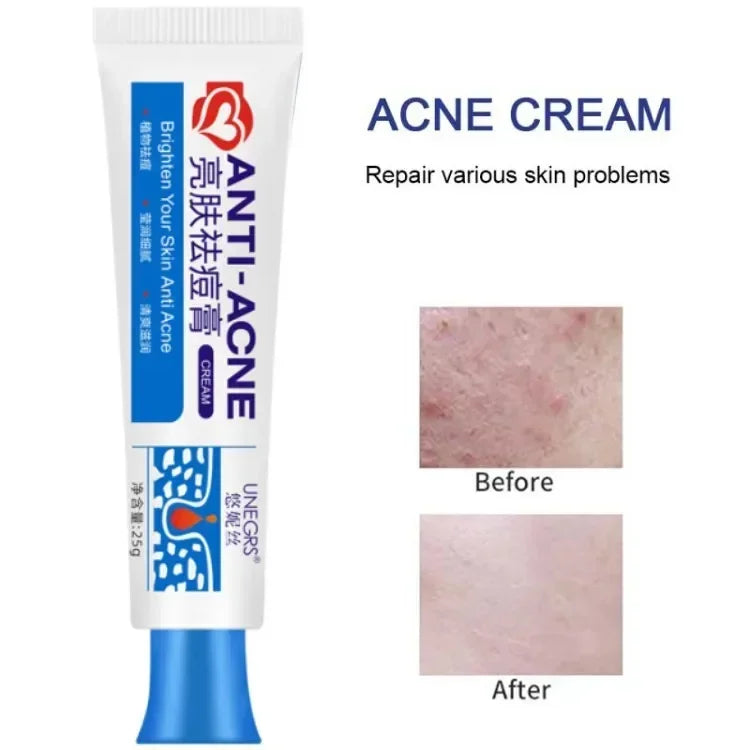 Herbal Acne Removal Face Cream Clears Pimple Scar Black Dots Gel Acne Treatment Shrink Pore Skin Whitening Lightening Ointment
