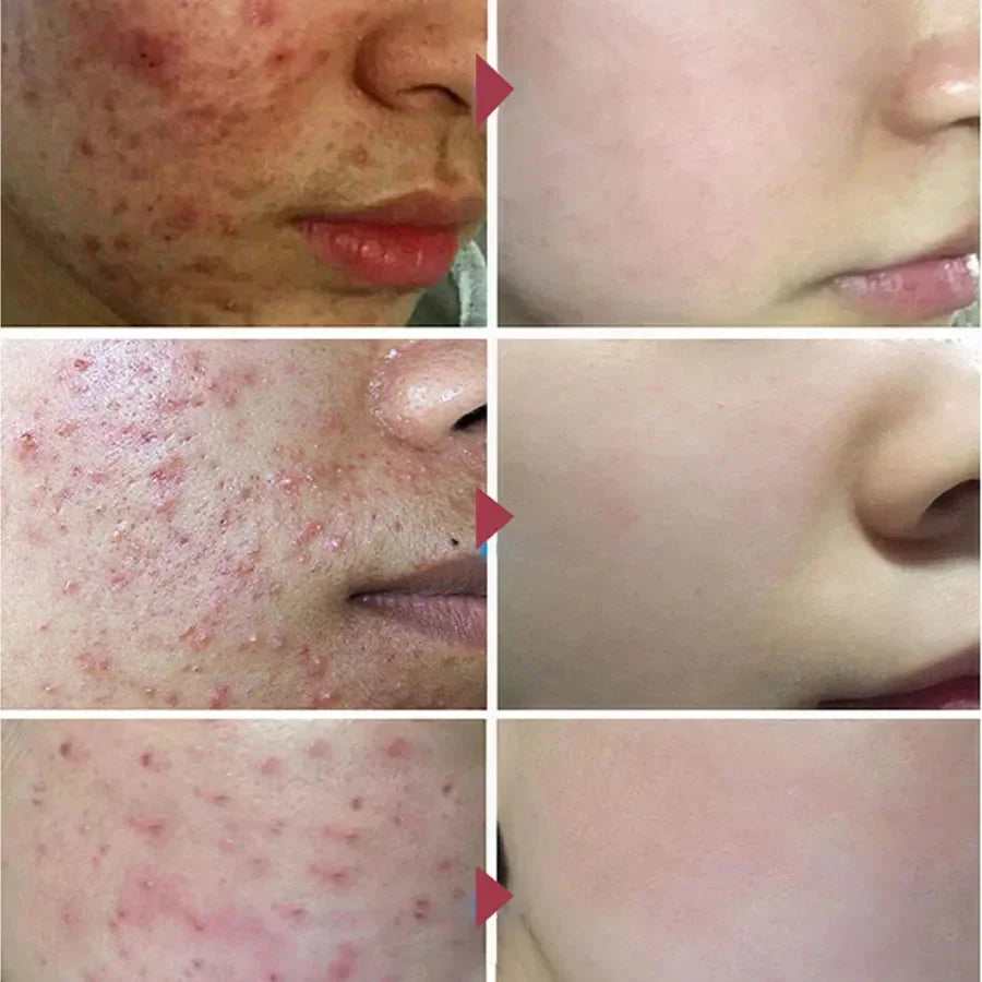 Herbal Acne Removal Face Cream Clears Pimple Scar Black Dots Gel Acne Treatment Shrink Pore Skin Whitening Lightening Ointment