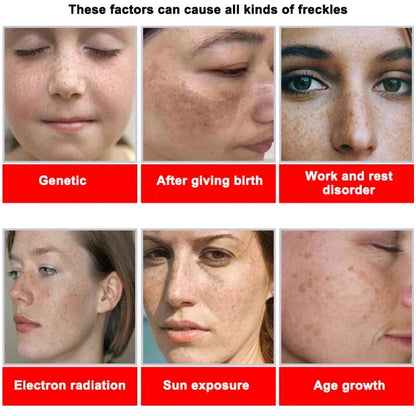 Powerful Dark Spots Remover Whiten Serum Cream Vitamin C Skin Brighten Serum Removal Melasma Dark Spots Repair Beauty Skin Care