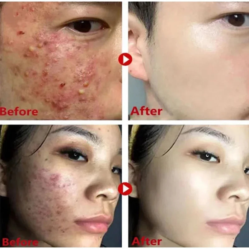 Remove Blackhead Mud Mask Green Tea Face Clean Stick Dispel Pimple Blemish Shrink Pores Oil Control Exfoliating Whiten Skin Care