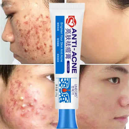 Herbal Acne Removal Face Cream Clears Pimple Scar Black Dots Gel Acne Treatment Shrink Pore Skin Whitening Lightening Ointment
