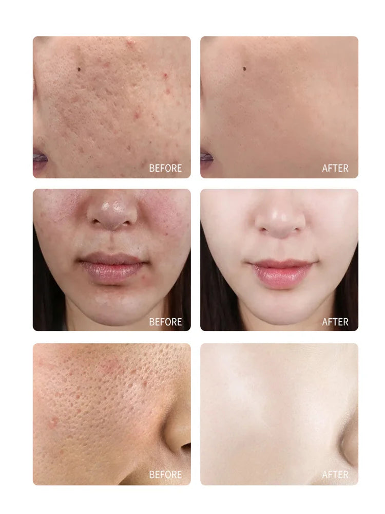 Reduce Acne and Dark Spots Anti-aging Essence Chemical Exfoliants Moisturizer Face Oils Salicylic Acid Face Peel Neutraliser