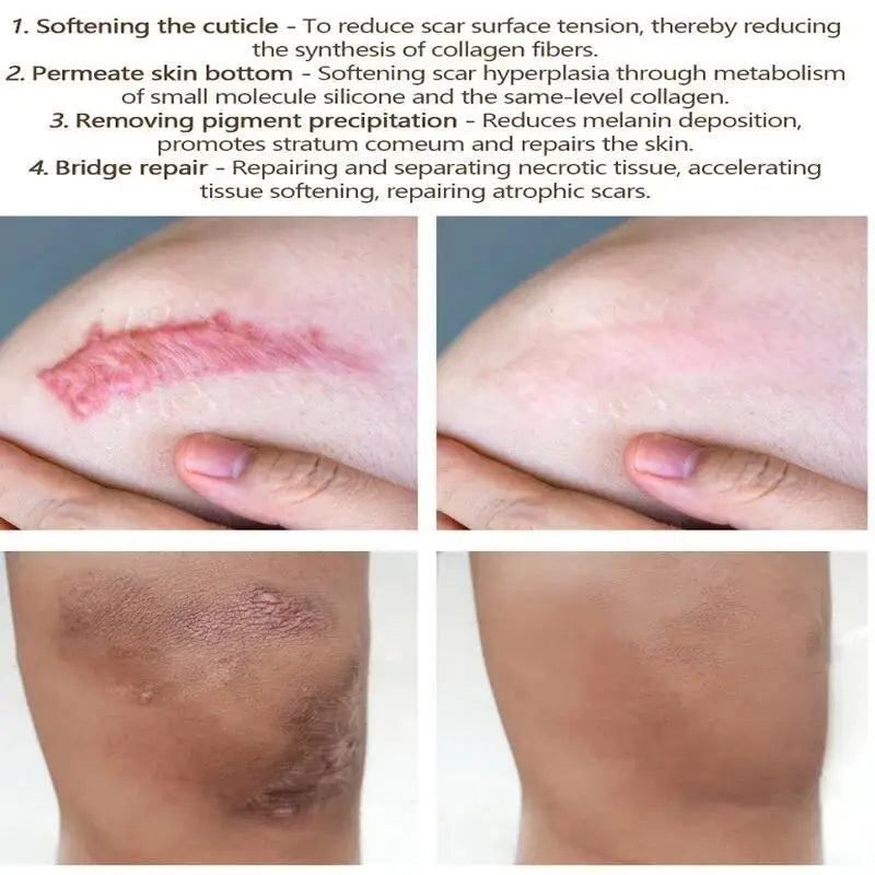 Fast Scar Removal Cream Effective Treatment Stretch Marks Burn Surgical Scars Acne Spot Repair Whiten Moisturize Herbal SkinCare