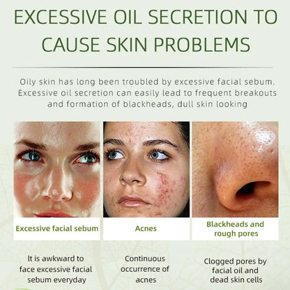 Herbal Acne Face Cream by JoyPretty - Pimple Marks RemovalOil Control & Moisturizing Facial Cream for Pockmark Smoothing