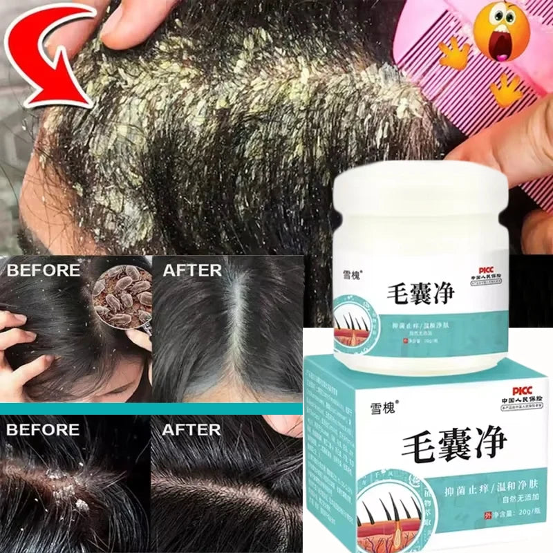 Fast Anti Dandruff Hair Treatment Scrub Itching Repair Scalp Cleaning Exfoliating Products Oil Control Antipruritic Hair Care