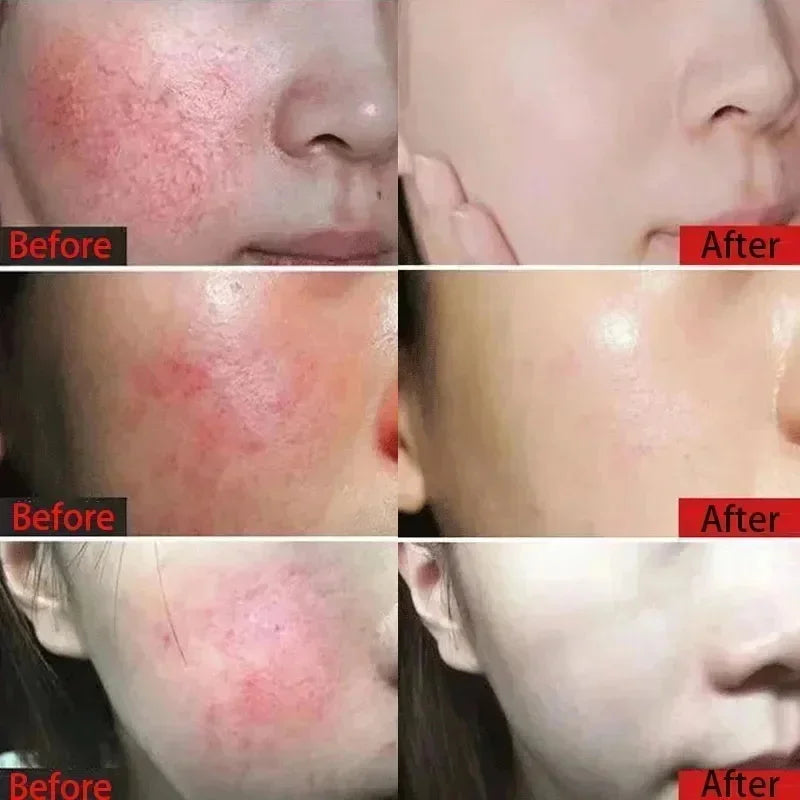 Facial Redness Repair Cream Improve Sensitive Muscles Acne Rosacea Dry&Itchy Skin Moisturizer Lotion Korean skincare products