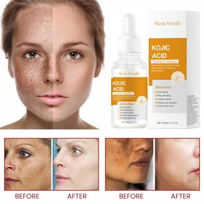 Kojic Acid Freckle Removing Whitening Essence Fade Pigmentation Melasma Dark Spots Corrector Repair Serum Korean Skin Care