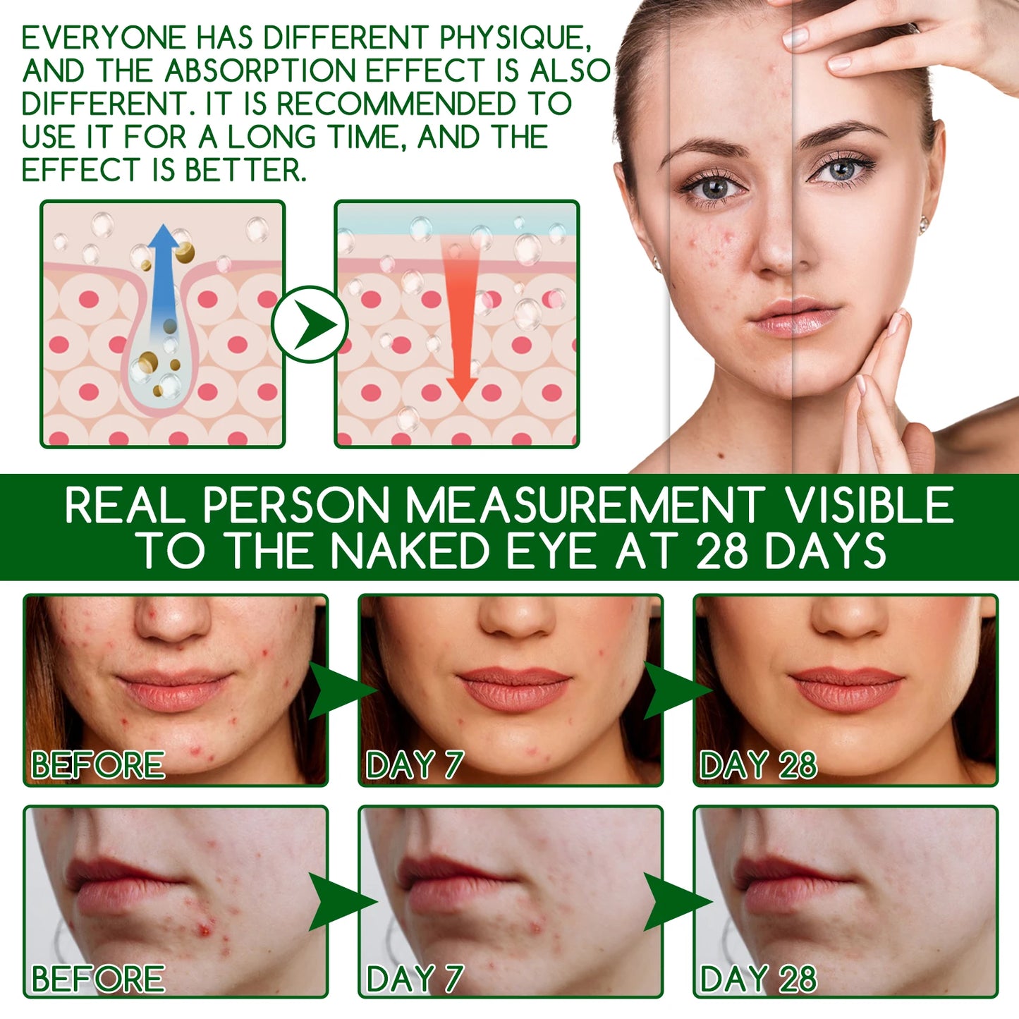 Salicylic Acid Anti Acn-e Serum Essence Controls Oil Shrinks Pores Removes Blackheads & Acne Repairs Acne Marks Moisturizes Face