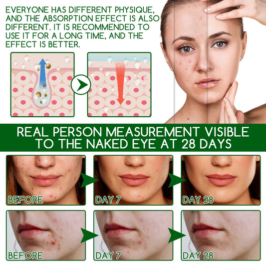 Salicylic Acid Anti Acn-e Serum Essence Controls Oil Shrinks Pores Removes Blackheads & Acne Repairs Acne Marks Moisturizes Face