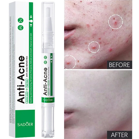Salicylic Acid Acne Treatment Face Serum Repair Pimple Spots Deep Cleaning Pore Anti-acne Scar Oil Control Moisturizer Skin Care