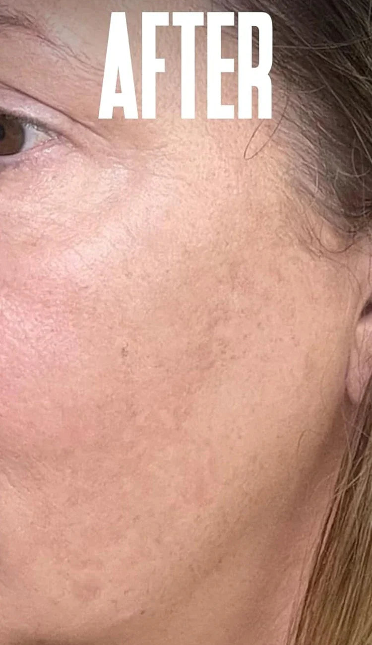 Niacinamide Melasma Brightening Cream Reduce Melanin Brighten Cream Lighten Dark Skin Chloasma Serum Fade Fine Face Lines