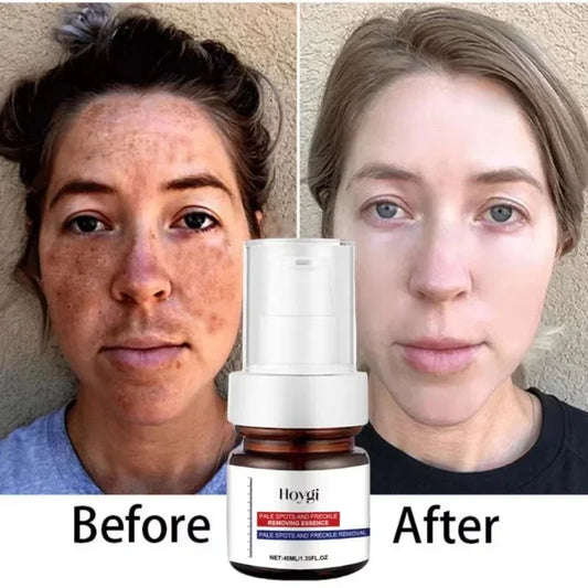 Powerful Dark Spots Remover Whiten Serum Cream Vitamin C Skin Brighten Serum Removal Melasma Dark Spots Repair Beauty Skin Care