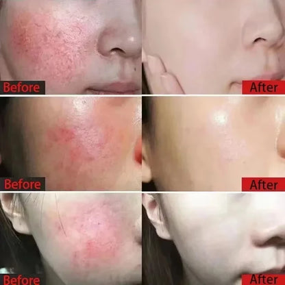 Facial Redness Repair Cream Improve Sensitive Skin Moisturizer Hydrate Sooth Lotion Removal Rosacea Spider Vein Korean Cosmetic