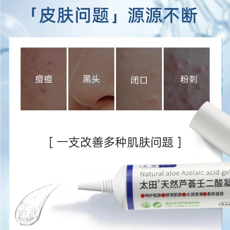 Natural Aloe Azelaic Acid Gel Acne Removal Cream Anti-Acne Repair Redness Pimple Spots Shrink Pores Remove Blackheads Skin Care