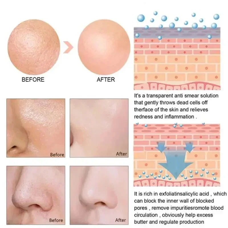 Lactic Acid Large Pores Removal Serum Facial Fast Eliminate Pore Shrinking Essence Firm Skin Moisturizing Hydration Care Product