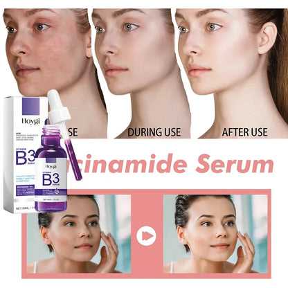 Hoygi Niacinamide Facial Serum Vitamin B3 Wrinkles Pigment Dark Spot Removal Correcting Glow Serum Face Whitening Moisturizer