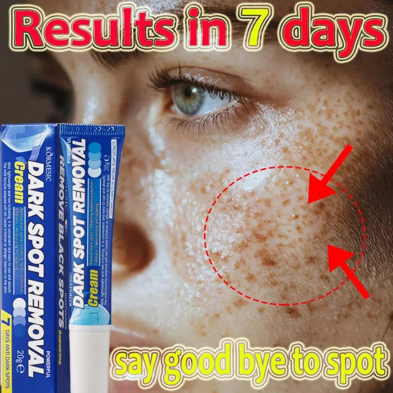 Effective Whitening Freckles Face Cream Remove Melasma Dark Spots Fade Pigmentation Acne Scars Moisturizing Brighten Beauty Care