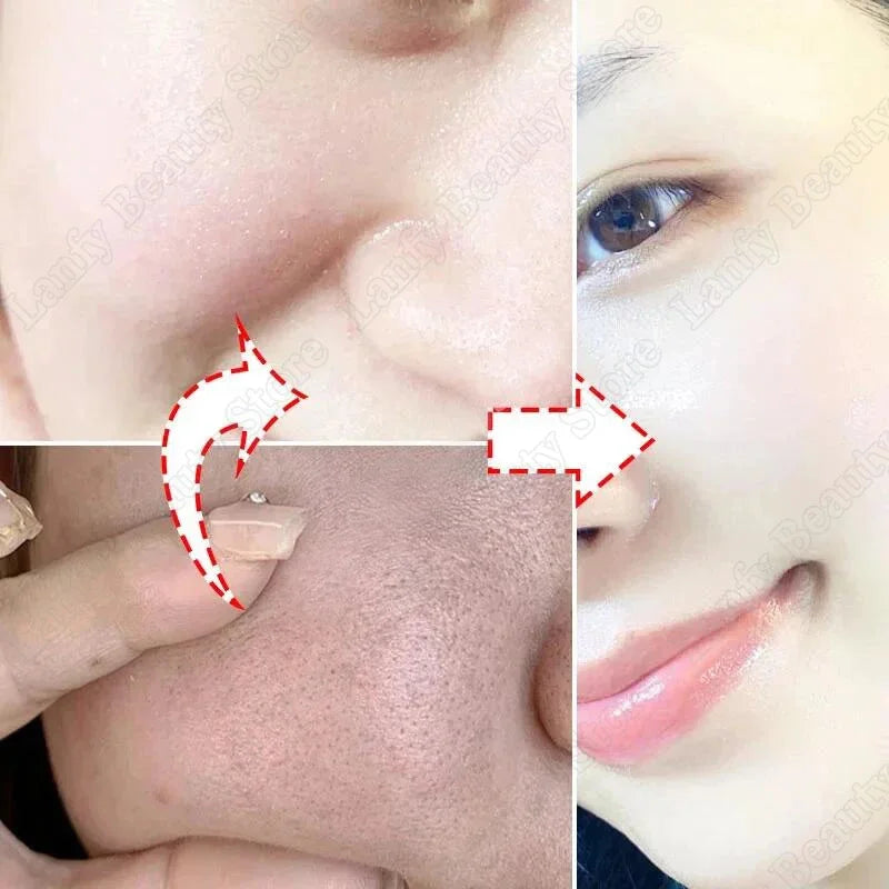 Salicylic Acid Pore Clearing Cream Shrink Pores Remove Blackheads Acne Brighten Moisturizing Smooth Skin Care Korean Products