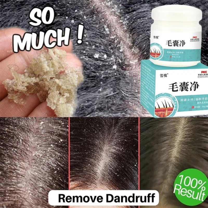 Fast Anti Dandruff Hair Treatment Scrub Itching Repair Scalp Cleaning Exfoliating Products Oil Control Antipruritic Hair Care