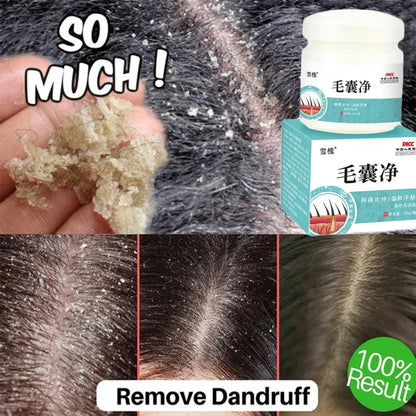 Fast Anti Dandruff Hair Treatment Scrub Itching Repair Scalp Cleaning Exfoliating Products Oil Control Antipruritic Hair Care