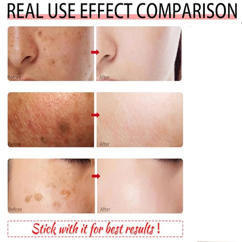 Removal Dark Spots Whitening Freckle Cream Leaving skin looking brighter clearer and more luminous prevent future discoloration