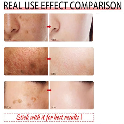 Removal Dark Spots Whitening Freckle Cream Leaving skin looking brighter clearer and more luminous prevent future discoloration