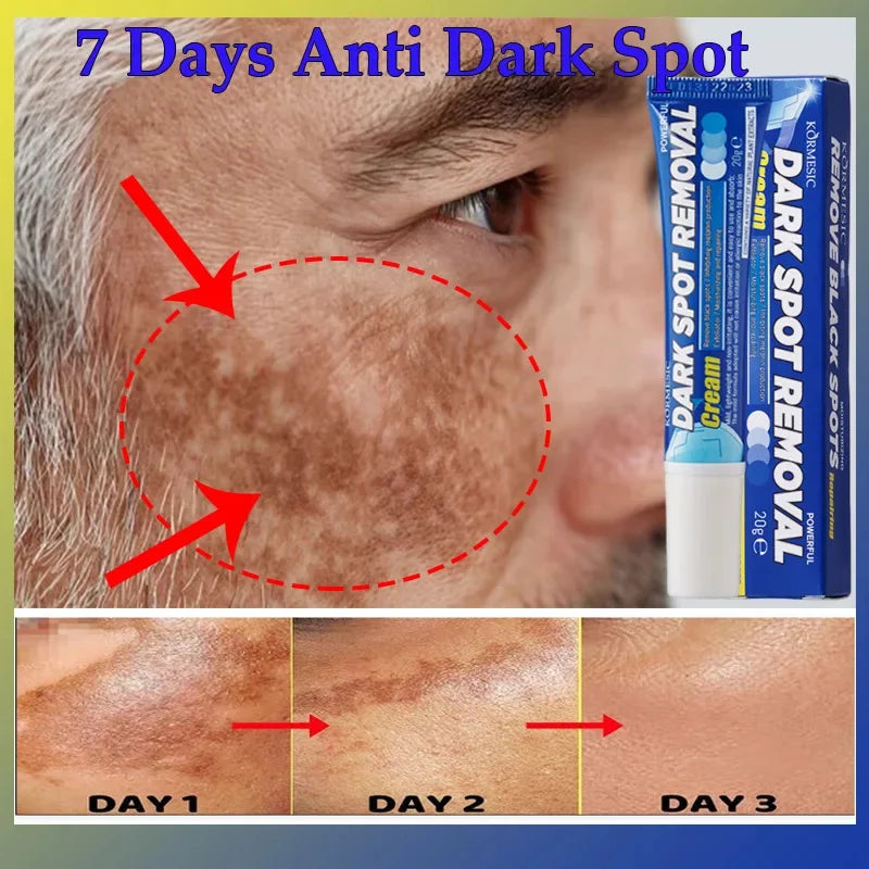 Effective Whitening Freckles Face Cream Remove Melasma Dark Spots Fade Pigmentation Acne Scars Moisturizing Brighten Beauty Care