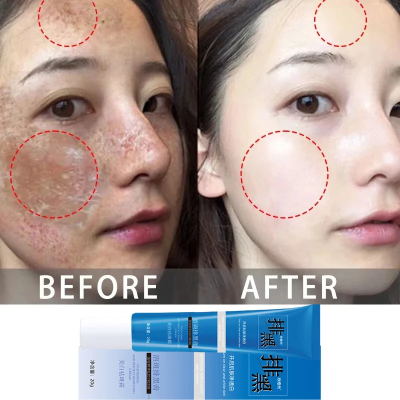 Dark Spots Removal Cream Facial Whitening Freckle Acne Mark Pigmentation Removal Melanin Skin Correction Brighten Care Products