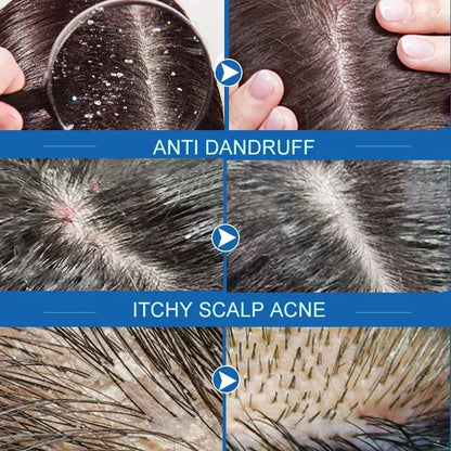 Fast Anti Dandruff Hair Treatment Scrub Itching Repair Scalp Cleaning Exfoliating Products Oil Control Antipruritic Hair Care