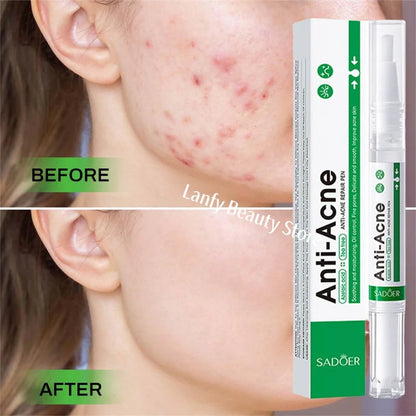 Salicylic Acid Acne Treatment Face Serum Repair Pimple Spots Deep Cleaning Pore Anti-acne Scar Oil Control Moisturizer Skin Care