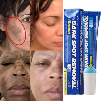 Effective Whitening Freckles Face Cream Remove Melasma Dark Spots Fade Pigmentation Acne Scars Moisturizing Brighten Beauty Care