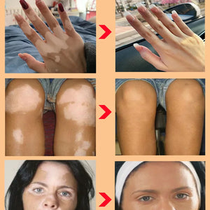 Effectively Remove Vitiligo Ointment Ringworm White Spot Removal Skin Vitiligo Eliminate Vitiligo Skin Care