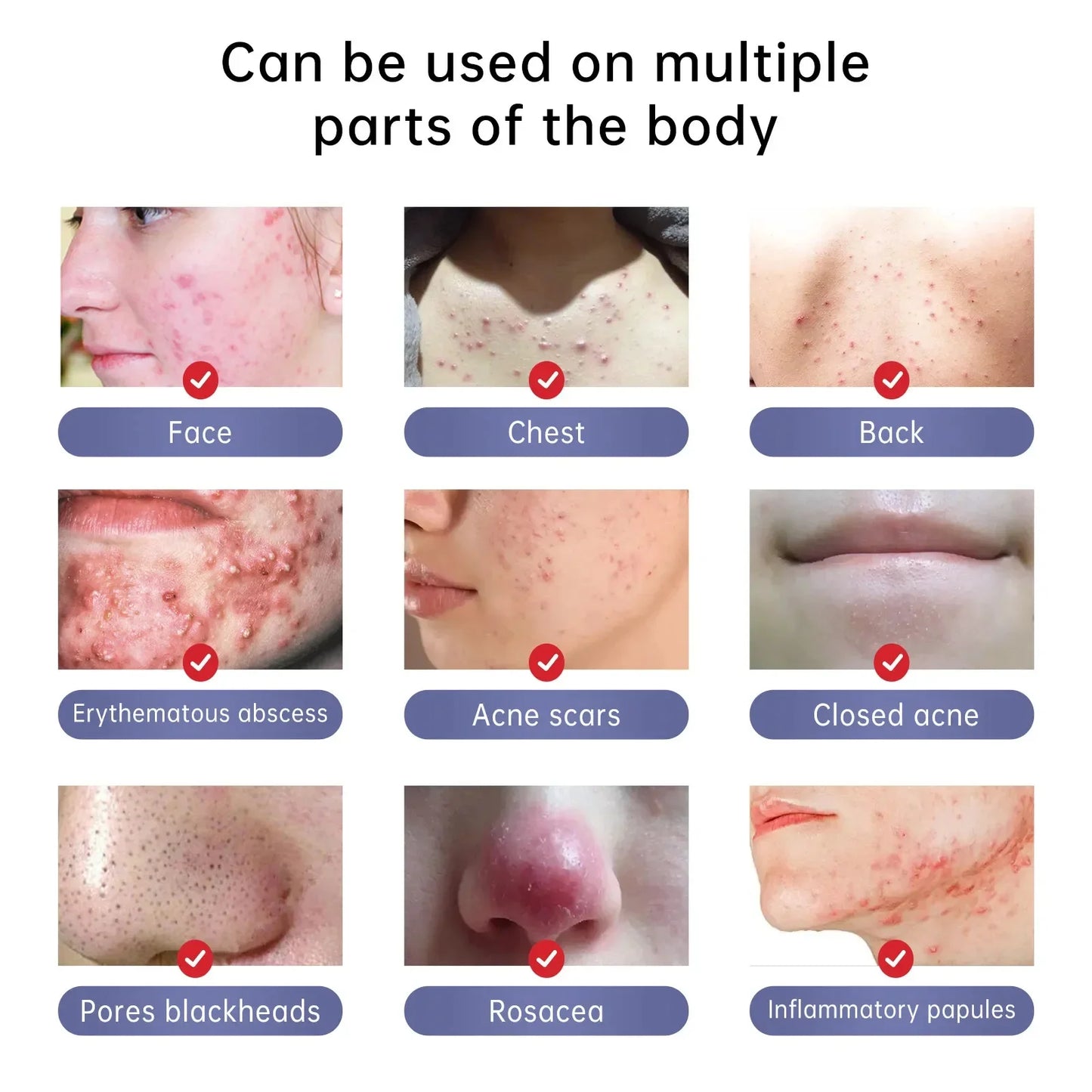 Herbal Acne Removal Face Cream Clears Pimple Scar Black Dots Gel Acne Treatment Shrink Pore Skin Whitening Lightening Ointment