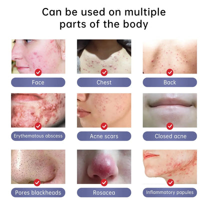 Herbal Acne Removal Face Cream Clears Pimple Scar Black Dots Gel Acne Treatment Shrink Pore Skin Whitening Lightening Ointment