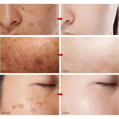 Kojic Acid Freckle Removing Whitening Essence Fade Pigmentation Melasma Dark Spots Corrector Repair Serum Korean Skin Care