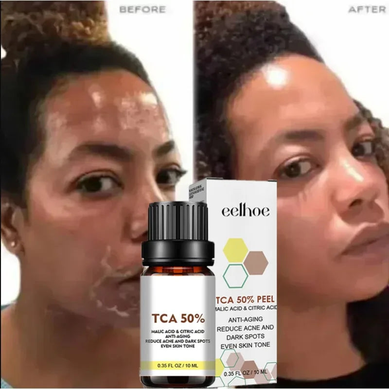 With Malic Acid And Citric Acid For Face  Facial Peel 40% Peeling Serum Peeling Serum Chemical Peel